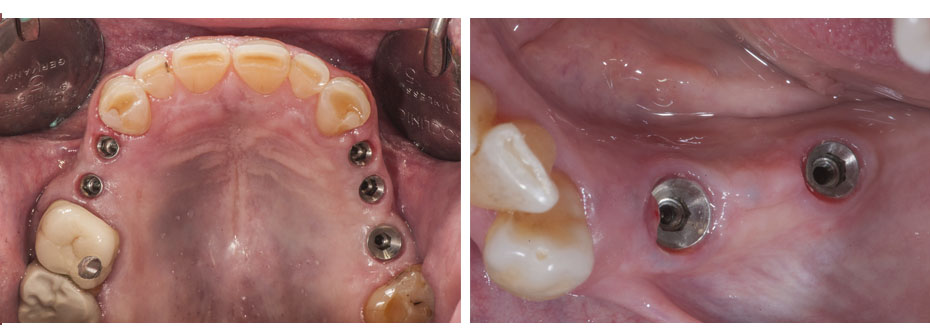 clinica-somosaguas-pozuelo-alarcon-implante2